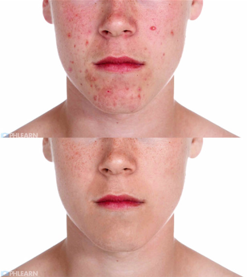 remove acne photoshop tutorial