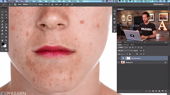 remove acne