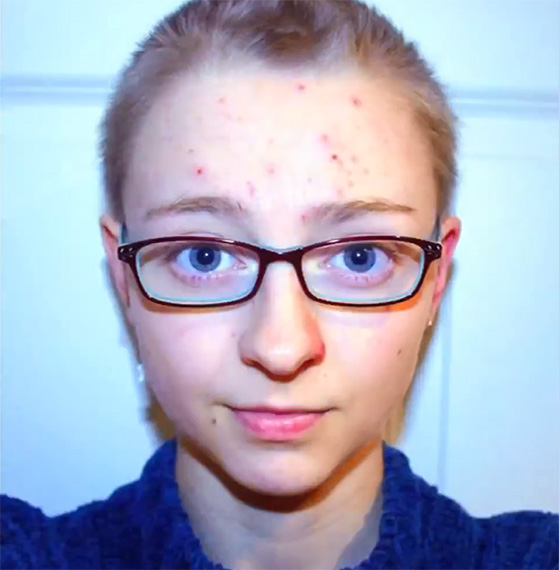 trichotillomania-self-portrait-project
